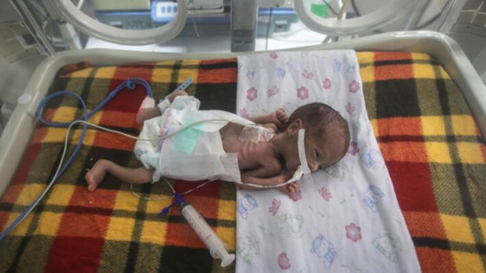 Ένα στα τρία παιδιά κάτω των δύο ετών στη Γάζα αντιμετωπίζει οξύ υποσιτισμό