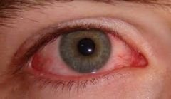 ΟΦΘΑΛΜΟΛΟΓΙΚΟΣ ΕΛΕΓΧΟΣ ΓΙΑ ΤΗΝ ΠΡΟΛΗΨΗ ΤΟΥ ΓΛΑΥΚΩΜΑΤΟΣ